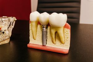 oral implant