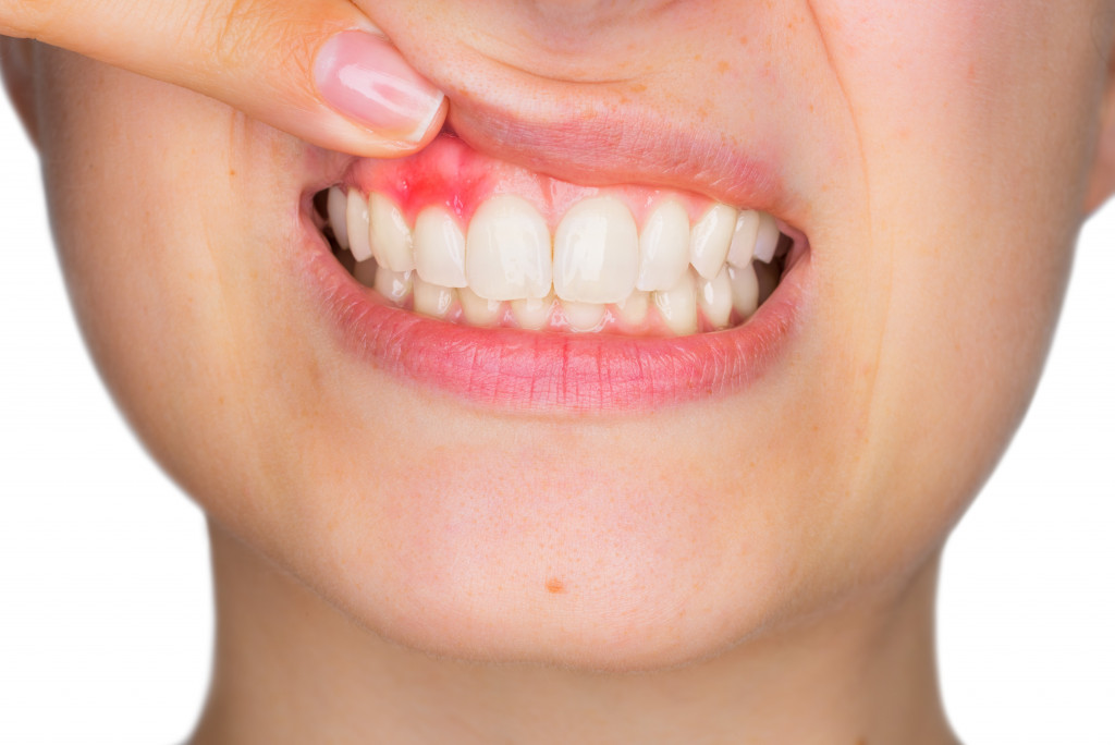 red inflamed gum of a woman