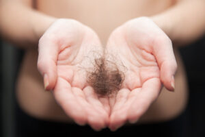 Woman having hair loss
