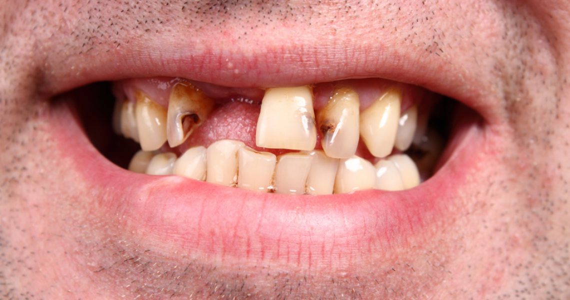 man with poor oral health concept