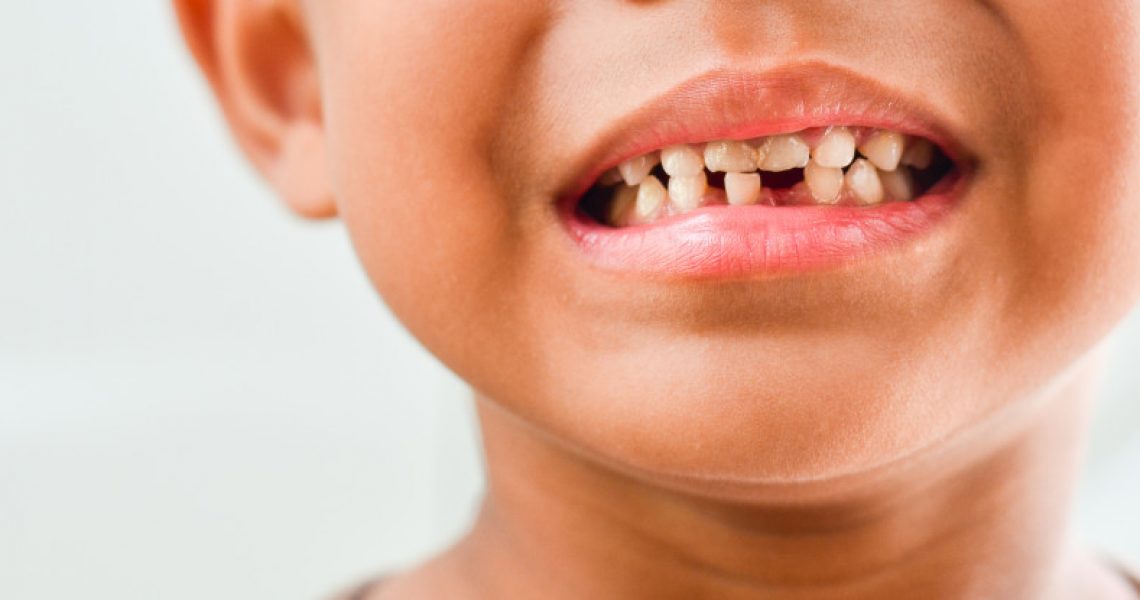 A child with a missing lower tooth